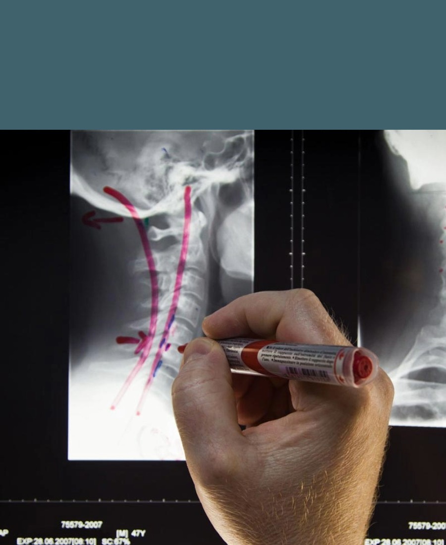 what is a pinched nerve 2